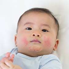 Image result for sweat rash on back baby
