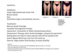 Lipedema Lipedema Lymph Massage Liposuction