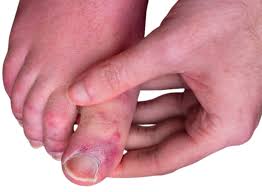 Image result for Chilblains