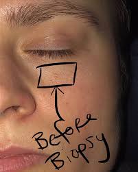 Image result for skin cancer on nose pimple