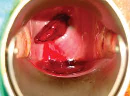 Ectopy is present with metaplastic epitheliumgrowing medially at 12 o'clock (containing crypt openings). Cervical Polyps Causes Symptoms Management Teachmeobgyn