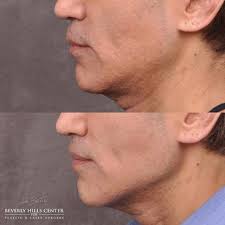 Learn more in this howstuffworks article. Male Plastic Surgery Before Afters Beverly Hills Center