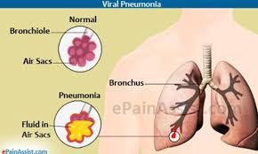 Early symptoms of viral pneumonia are the same as those of bacterial pneumonia. Viral Pneumonia Treatment Causes Symptoms Signs Risk Factors