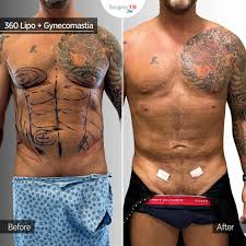Image result for Gynecomastia