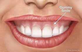 Browse the use examples 'gingivitis' in the great english corpus. Frequently Asked Questions Graf Orthodontics Orem Utah