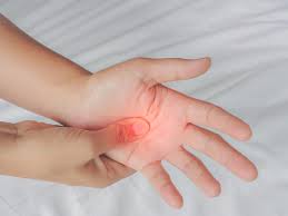Carpal Tunnel Syndrome Gejala Penyebab Dan Pengobatan Hello Sehat