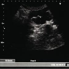 More than 101,400 people will be diagnosed with colon cancer and. Pdf The Value Of Abdominal Ultrasound In The Diagnosis Of Colon Cancer