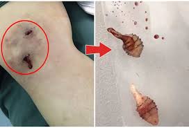 Hasil gambar untuk 3. Penyakit chagas