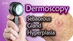 Image result for Sebaceous Gland