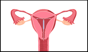 No side effects and no weight gain. Do Iuds Cause Weight Gain Here Are The Facts Goodrx