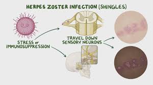 Image result for herpes zoster