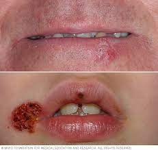 A herpes virus that causes cold sores and fever blisters in and around the mouth. Cold Sore Symptoms And Causes Mayo Clinic