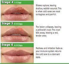 We did not find results for: Abreva Cold Sore Cold Sore Treatment Cold Sore Stages Cold Sore