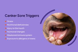 Image result for Canker sores roof of mouth