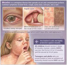 Image result for measles