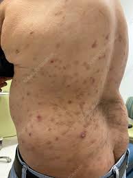 Image result for Lymphoma