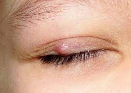 Arpacik Duasi Okunusu Ve Anlami Arpacik Gen Tr Eyestyeremedies Eye Stye Remedies At Home Face Mask Natural Treatments