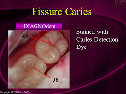 Caries detector dye in clinical practice, criteria used as a guide to diagnose dentin carious lesion is based in 1972, a caries detecting dye was introduced by fusayama and terashima (fusayama in addition to the correlation of dye staining and level of infection, sunago and others (sunago et al. Powerpoint Instructions To Advance To The Next Slide Bullet Point Or Image Simply Click The Left Mouse Button Ensure The Arrow Is Not On An Icon If Ppt Download