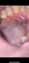 Image result for Mouth ulcers symptoms roof of the mouth