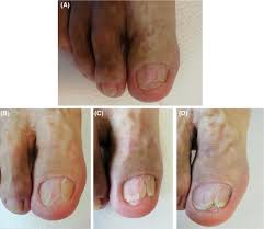 Image result for Onycholysis feet