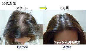女性の薄毛と女性発毛実績 感想 髪の育毛 薄毛 女性 薄毛
