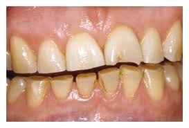 Image result for Tooth Attrition