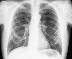 Image result for Pulmonary Contusion