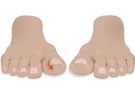And it all depends on how thick your nails are. Ingrown Toenail Causes