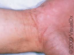 Image result for scabies human bites
