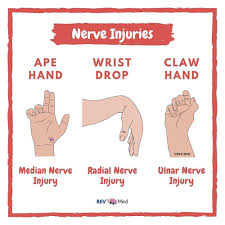 Doctor Medicine On Instagram Median Nerve Ape Hand Compression Of The Median Nerve Within The Carpal Tunnel Will Ca In 2021 Median Nerve Nerve Nursing Books