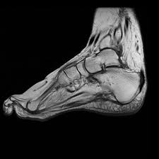 Charcot foot refers to an inflammatory pedal disease based on polyneuropathy; Charcot Marie Tooth Disease Hmsn Radiology Case Radiopaedia Org