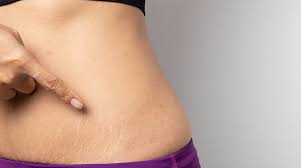 Gender studies · 9 years ago. Why Some People Get Stretch Marks And Others Don T Venus Treatments