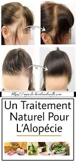 Un Traitement Naturel Pour L Alopecie Alopecia Treatment Trendy Bob Hairstyles Hair Fall Solution