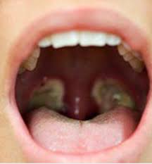What To Expect After A Tonsillectomy Ent4kids
