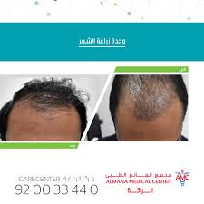 وحدة زراعة الشعر في مستشفيات المانع