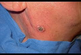 Merkel cell carcinoma, also called neuroendocrine carcinoma of the skin or trabecular cancer, is a very rare type of skin cancer that forms when merkel a swollen lymph node is felt during a physical exam and/or seen on an imaging test. Merkel Cell Carcinoma Picture Image On Medicinenet Com