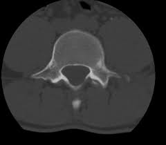It occurs as a result of sudden and extreme trauma. Transverse Process Fracture Radiology Case Radiopaedia Org