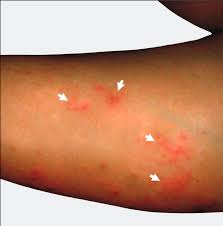 Image result for Trombicula autumnalis bites