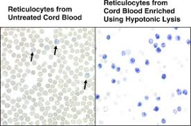 Image result for Reticulocyte Count