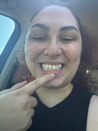 Looking for a good Dentist for veneers in NJ