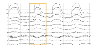 Eeg Electroencephalography The Complete Pocket Guide