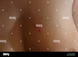 Insect bite marks on woman chest breast Stock Photo - Alamy