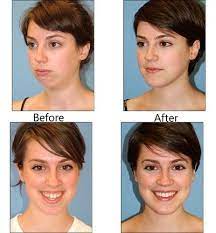 The introduction of medisave life and integrated shield plans may go a long way to help patients afford corrective jaw surgery. Orthognathic Surgery In Palani Town Dindigul Id 7917260348