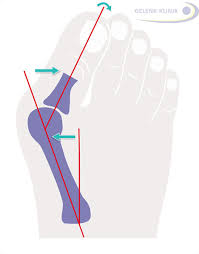 Bei starker ausprägung und starken schmerzen ist die hallux valgus operation die erfolgreichste behandlung. Hallux Valgus Operation Korrektur Der Stellung Der Grosszehe Gelenk Klinik De