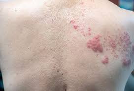 The rash typically begins as urticarial wheals that coalesce into palpable purpura, typically in the lower extremities and buttocks. When To Worry About A Rash In Adults 8 Skin Warning Signs