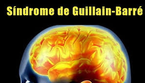 El sgb puede causar síntomas que por lo general duran algunas semanas. Sindrome De Guillain Barre Espana Photos Facebook