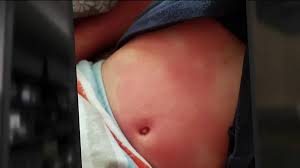 This is the most specific covid rash as not many other skin conditions present in this way. Children And Coronavirus Multiple Kids Sickened By Pediatric Multi System Inflammatory Syndrome Nbc Boston