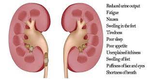 Kidney cancer, also known as renal cancer, is a group of cancers that starts in the kidney. Chronic Kidney Disease Facts Symptoms Warning Signs Treatment