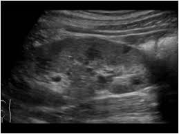 Autosomal Dominant Polycystic Kidney Disease Adpkd Polycystic Kidneys Polycystic Kidney Disease Kidney Disease