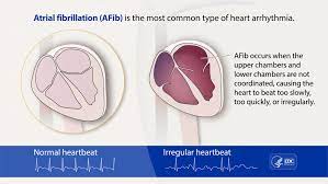 By claybabe16881 | 14 posts, last post over a year ago. Atrial Fibrillation Cdc Gov